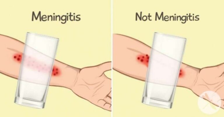 8 Simptomat e Meningjitit që çdo prind duhet t’i dijë ti dallojë në kohë
