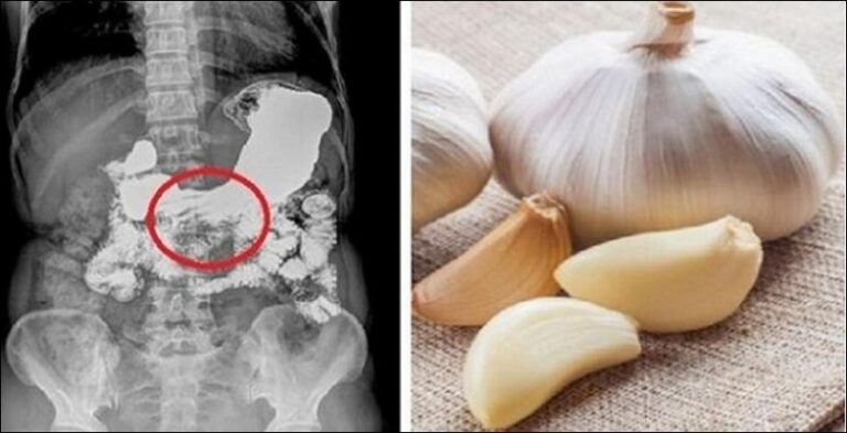 Kujdes! Njerëzit që vuajnë nga kjo sëmundje e kanë të ndaluar nga mjeku të përdorin hudhrën
