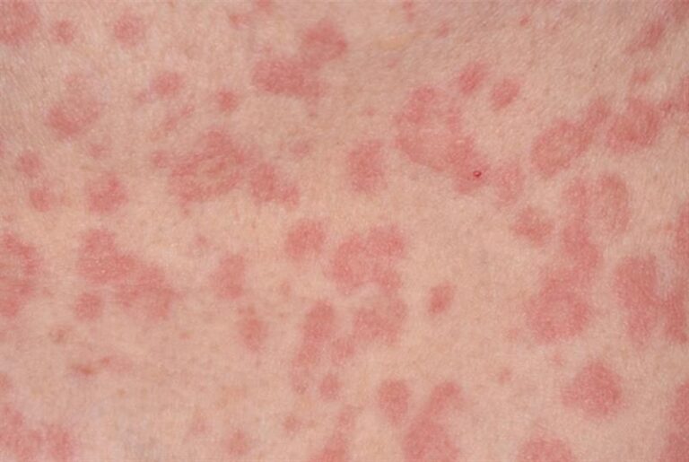 Shkencëtarët: Personat me koronavirus kanë shfaqur simptoma dhe në lëkurë, ja çfarë duhet të dini