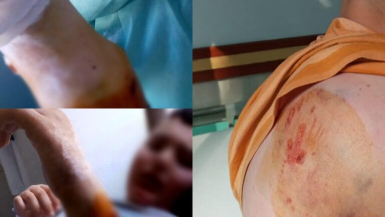 Pamje të rënda/ Qeni kafshon fëmijën, aktivistët i sulen Bashkisë pse e sterilizoi