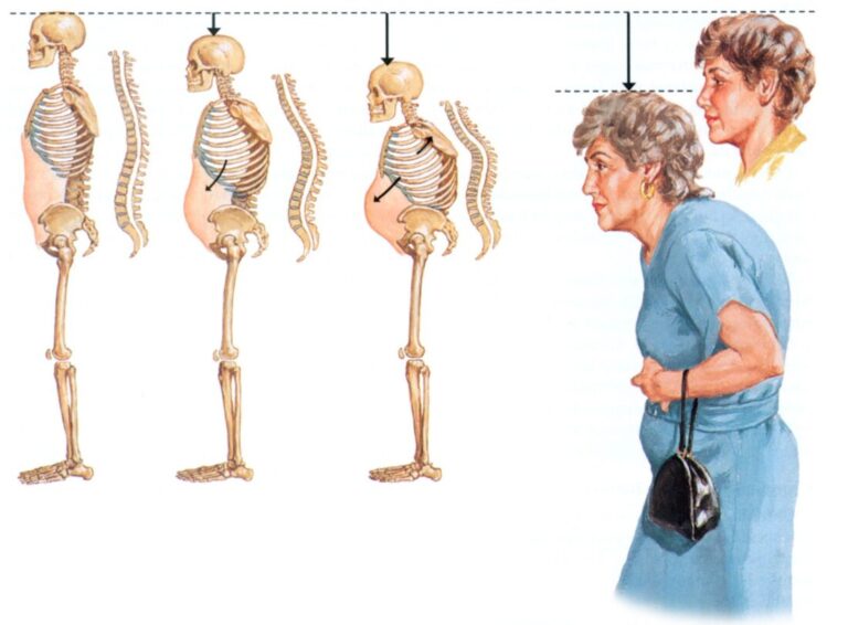 Një në dy gra dhe një në katër burra të prekur nga osteoporoza