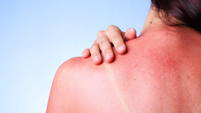Dermatologu këshillon se çfarë nuk duhet të bëni kur digjeni nga dielli