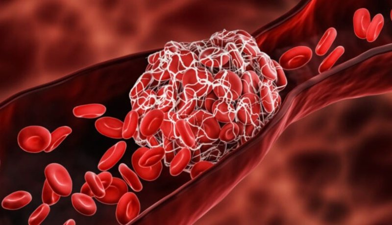 rreziku-i-heshtur-i-mpiksjes-se-gjakut-simptomat-qe-shpetojne-jete-dhe-si-te-reagojme