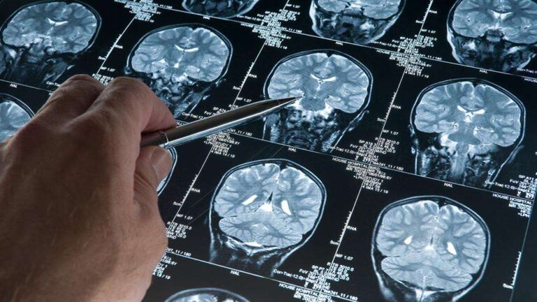 “Neurology”: Të lexuarit dhe aktivitetet mendore, potenciale në frenimin e progresit të Alzheimerit