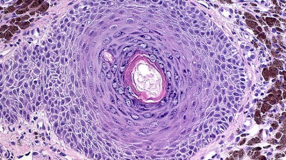 Metastazat e kancerit  jo si shpërndarje rastësore  por si struktura të organizuara me një logjikë të brendshme befasuese